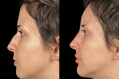 Facial Harmonization miami