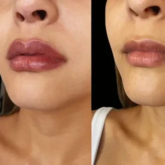 Lip Filler miami
