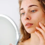 Does Collagen Help With Acne