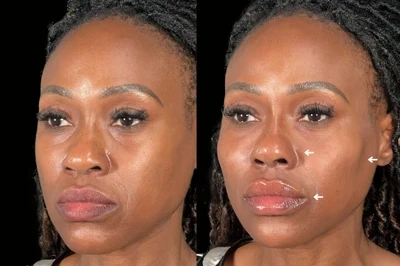 Facial Harmonization miami 01