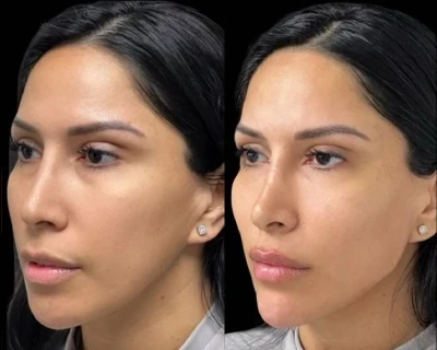 Facial Harmonization miami 04
