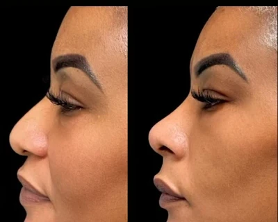 Non Surgical Nose Job miami 02