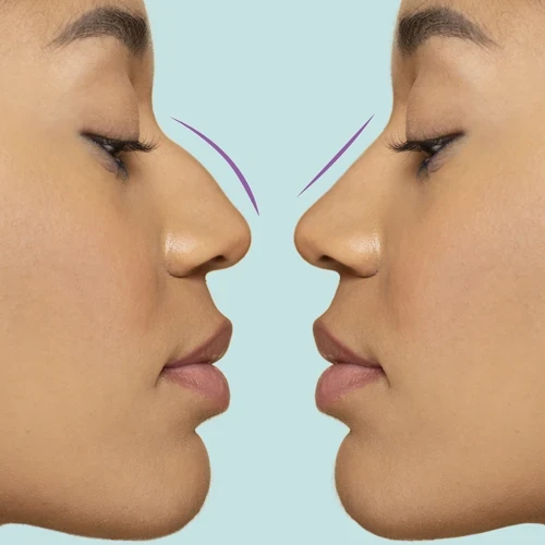 Bulbous Nose Tip Without Surgery