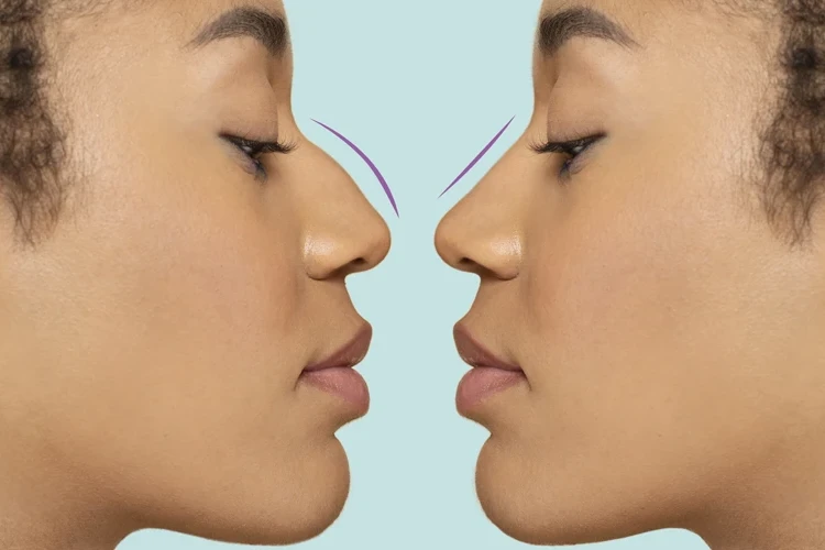 Bulbous Nose Tip Without Surgery