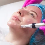 How Many Microneedling Sessions for Acne Scars