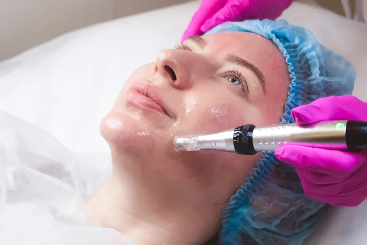 How Many Microneedling Sessions for Acne Scars