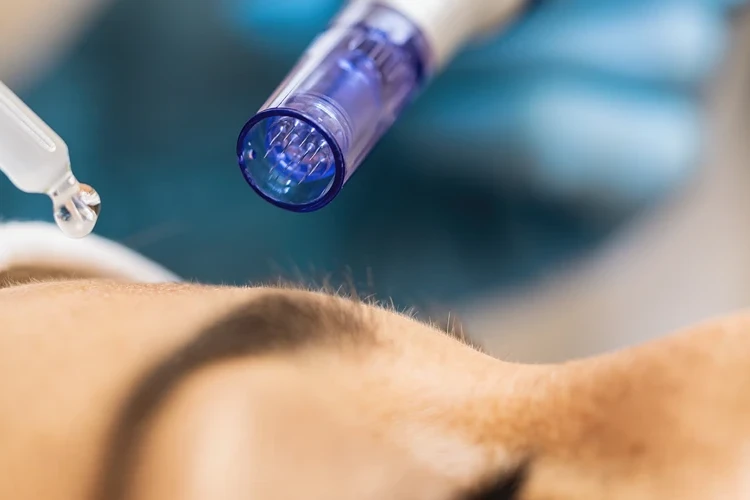 How to Treat Breakouts After Microneedling