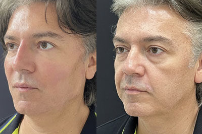 Facial Balancing miami 01