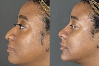 Non Surgical Nose Job Miami 02 B&A