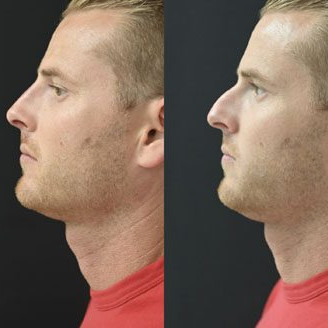 Non Surgical Nose Job Miami 06