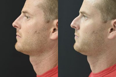 Non Surgical Nose Job Miami 06