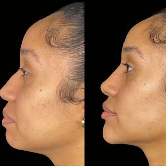 Chin & Jawline Filler miami 01