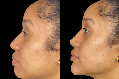 Chin & Jawline Filler miami 01