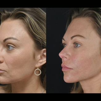 Facial Balancing miami 05