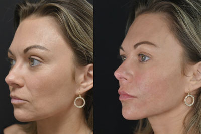 Facial Balancing miami 05