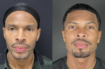 Facial Balancing miami 10