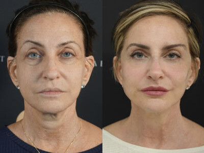 Facial Balancing miami 11