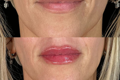 Lip Filler Miami 07