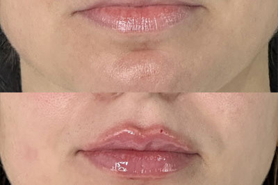 Lip Filler Miami 09