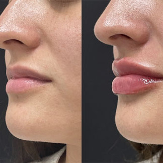 Lip Filler Miami 11