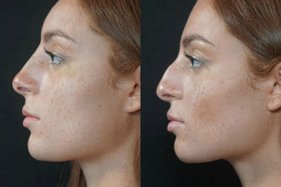 Non Surgical Nose Job Miami 07