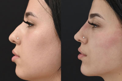 Non Surgical Nose Job Miami 09