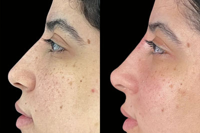 Non Surgical Nose Job Miami 12
