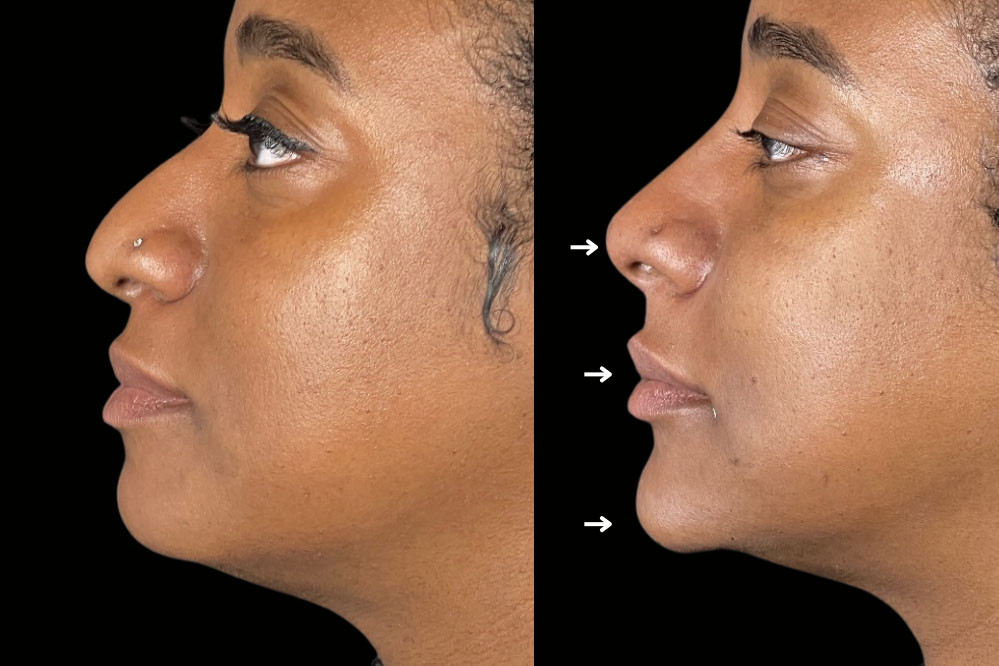 Non Surgical Nose Job Miami