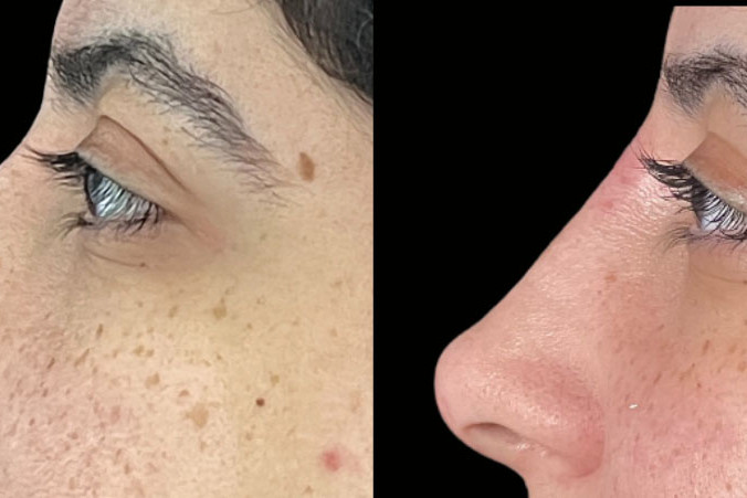 Non Surgical Nose Job Miami 21