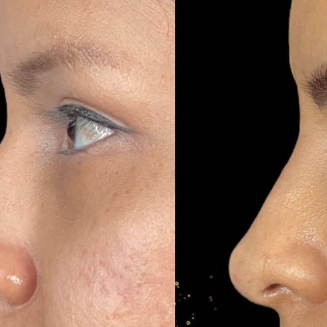 Non Surgical Nose Job Miami 24