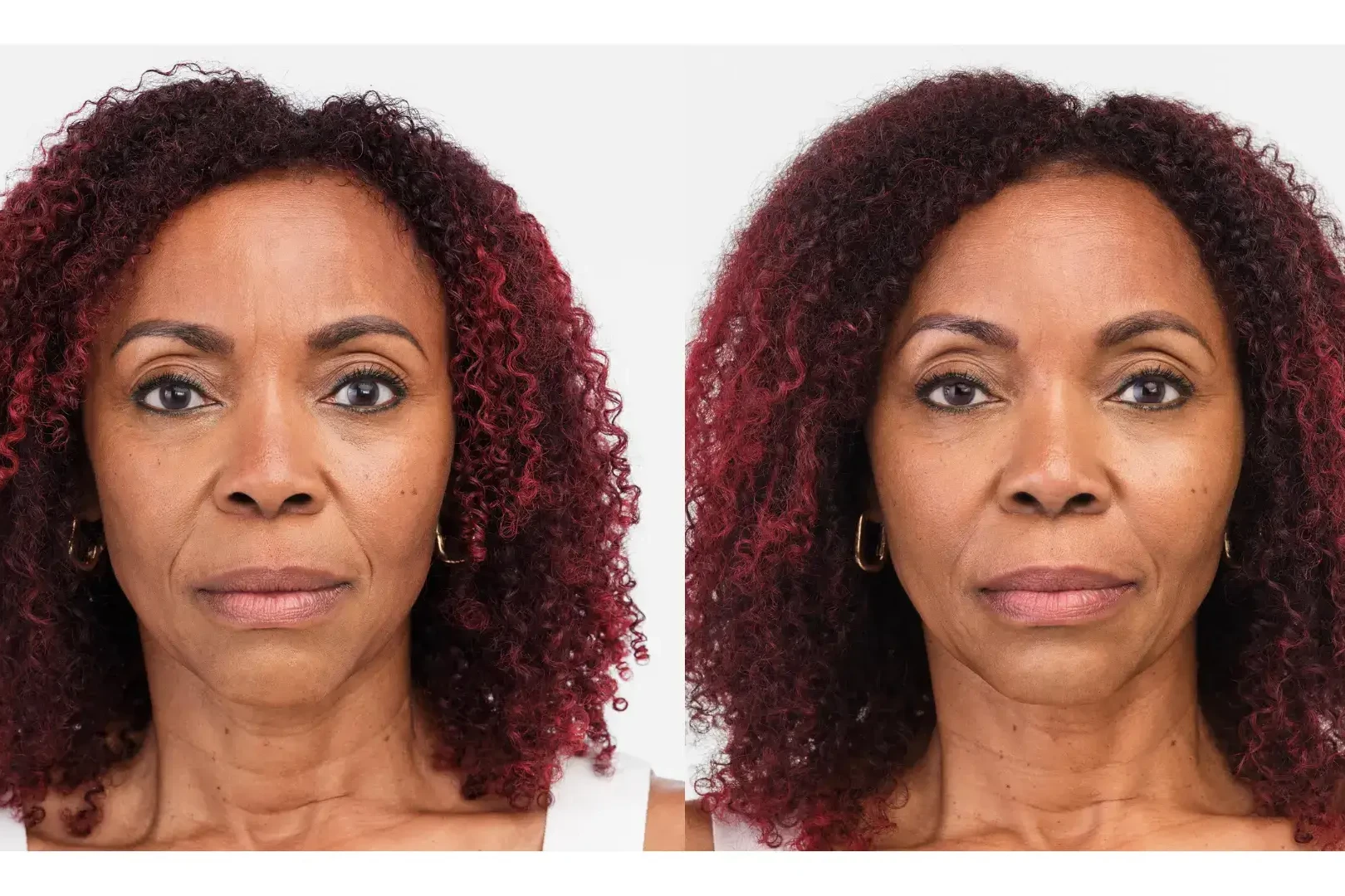 radiesse treatment uai