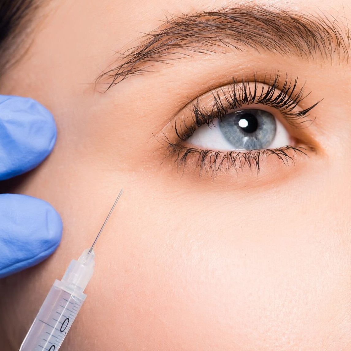 under eye fillers uai
