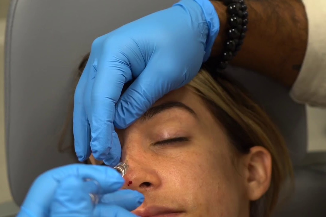 non surgical nose job fixing indentation uai